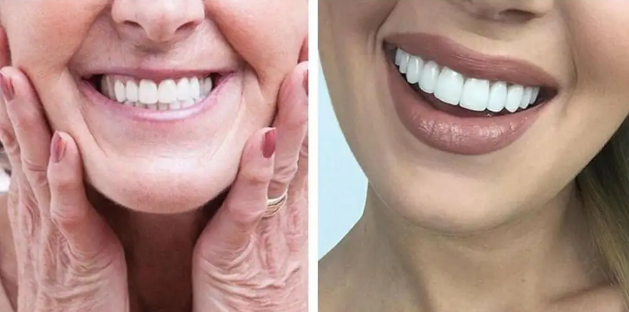 CARILLAS DENTALES SNAP ON SMILE PAGA 1 LLEVA 2